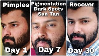 Do you have Dark Spots Pigmentation Just follow this for 100  gauranteed Result 👍  Tamil [upl. by Leoni]