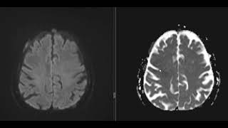 CASE 9 A KNOWN CASE OF bronchogenic carcinoma [upl. by Noxin]