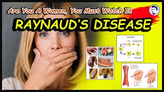 What is Raynaud Disease  Causes  What are the Treatments  Complications  English  2022 [upl. by Tniassuot]