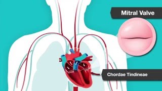 Understanding Heart Murmurs Aortic and Mitral Valve Problems [upl. by Warfeld]