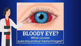 Subconjunctival Hemorrhage Blood in Eye [upl. by Imoyn]