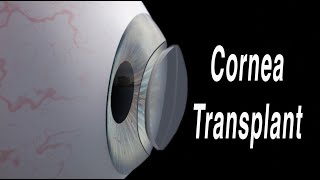 Cornea Transplant Penetrating Keratoplasty [upl. by Anibur]