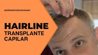 O que é a hairline no transplante capilar [upl. by Bartle17]