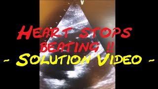 Cardiology Echo QuizCase Heart stops beating Part 2 Solution video [upl. by Tillo]