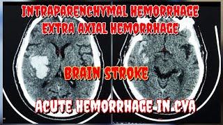 Large Intraparenchymal Hemorrhage and Extra axial Hemorrhage  Sub arachnoid Hemorrhage  Prasad [upl. by Obmar742]