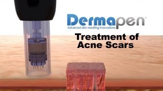 MicroNeedling for Acne Scars  Dermapen® Treatment [upl. by Zoilla]