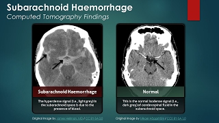 Subarachnoid Hemorrhage SAH Computed Tomography Scan Findings [upl. by Naresh41]