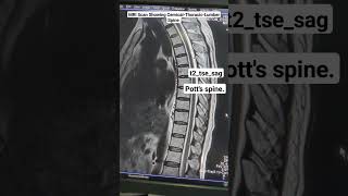 MRI Scan of Spine Showing Potts CervicalThoracicLumber Spine t2tsesag Sequence beginners [upl. by Aikin]