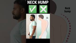 HOW TO FIX A NECK HUMP  NECK HUMP EXERCISE  neckpain neckhump karatesir [upl. by Acimot47]