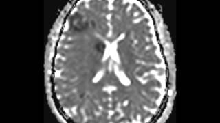 Moyamoya Syndrome Secondary to Sickle Cell Disease [upl. by Basham]