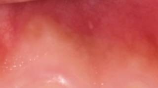 यह लक्षण दिखें तो तुरंत डॉक्टर के पास जाइए मुंह का कैंसर हो सकता है Mouth Cancer Ke Lakshan Symptoms [upl. by Nidnal130]