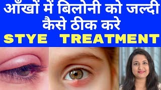 STYE ON EYELID  बिलोनी का होम्योपैथिक इलाज  FAST AND EFFECTIVE TREATMENT FOR STYE [upl. by Tedder343]