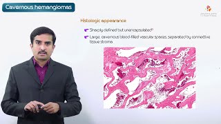 Cavernous hemangioma  Pathology Usmle step 1 [upl. by Novoj]