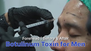 Vellux Botulinum Toxin for Men [upl. by Warring908]