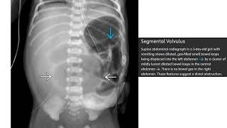 Segmental Volvulus Imaging [upl. by Mohandis198]