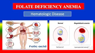 FOLATE DEFICIENCY ANEMIA  Definition types cusses pathophysiology signs amp symptom medicine [upl. by Rednave59]