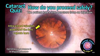 CataractCoach™ 2327 Cataract Quiz How do you proceed safely Intravitreal injection lens puncture [upl. by Asirrak]