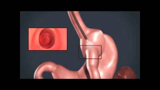 Apollo Overstitch Endoscopic Revision Procedure [upl. by Nnylyma]