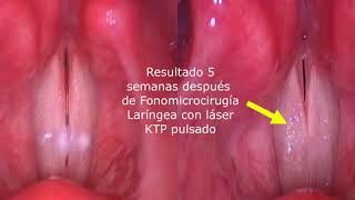 TRATAMIENTO NÓDULOS DEL CANTANTE⁣  NÓDULOS DE CUERDAS VOCALES  VOCAL FOLD NODULES TREATMENT [upl. by Bolte648]