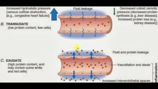 PATHOLOGY LECTURES  Hemodynamic Disorder  EXUDATES and TRANSUDATES [upl. by Sucul]