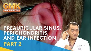 Preauricular Sinus Perichondritis and Ear Infection Part 2  Usapang Pangkalusugan [upl. by Latsirk]