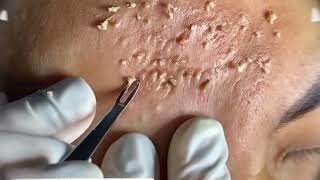 Acne amp Blackhead Treatment Blackhead Removal on forehead  Remove Blackhead removeblackhead [upl. by Ballard]