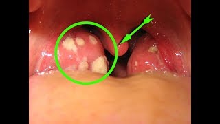 Remove Tonsil Stones With Cotton Swab  tonsils with white dots [upl. by Ohcamac]