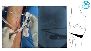 Osteotomía tibial proximal osteotomía Monoplanar vs Biplanar [upl. by Annohsat]