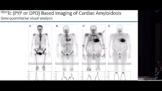 4 El rol de la multimodalidad en el DX amiloidosis cardíaca Dr Gabriel Grossman [upl. by Nnarefinnej521]