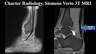 Highgrade Partial Achilles Tendon Tear [upl. by Einafets]