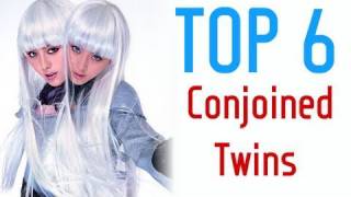 Top Six Conjoined Twin Pairs in History [upl. by Boelter]