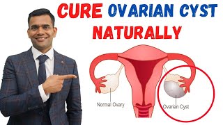 Just 3 Recommendations To Cure Ovarian Cyst Naturally  Dr Vivek Joshi [upl. by Courcy]