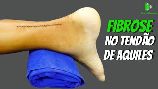 Como acontece a fibrose no tendão de Aquiles após a cirurgia  FISIO EM MOVIMENTO [upl. by Hanleigh910]