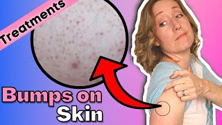 Red Bump on Your Arms  How to Treat Your Keratosis Pilaris at Home [upl. by Wilmott259]