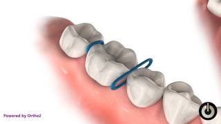 Elastic Separator  Dental Braces  Temecula Valley CA [upl. by Burk]