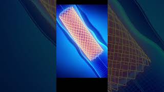 3D Animation of Angioplasty Heart Procedure Medical Animation Explained [upl. by Naujit]