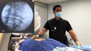 Radiofrequency Ablation Procedure [upl. by Catherine]