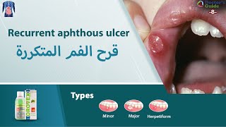 قرح الفم  Recurrent aphthous ulcer 8Doctors Guide [upl. by Joell]