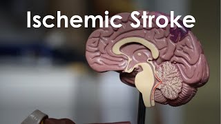 Ischemic Stroke and Transient Ischemic Attack for USMLE Step 1 and Step 2 [upl. by Amekahs240]