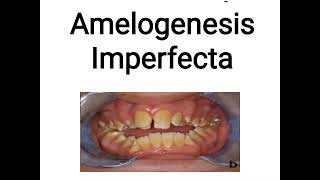 Amelogenesis Imperfecta [upl. by Etteluap]