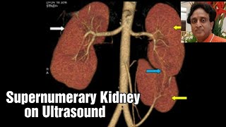 Supernumerary Kidney on Ultrasound differentiate from Duplex kidney Tips and tricks फालतू गुर्दा [upl. by Tish566]