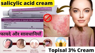 Clobetasol propionate and salicylic acid ointmentTopisal 3 cream Salicylic acid creamAcne [upl. by Bore]