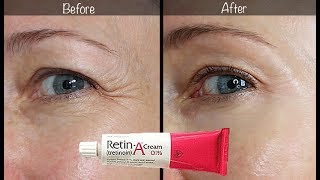 5Year RetinA Update  Before amp After for Wrinkles amp AntiAging [upl. by Burnham55]