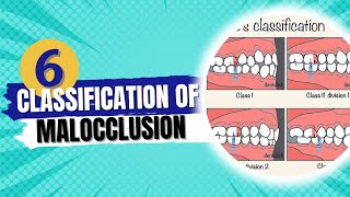 Classification of malocclusion  Orthodontics course [upl. by Parris764]