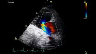 Pulmonary Embolism  Mcconnells Sign  Transthoracic Echocardiogram TTE [upl. by Nnyla]