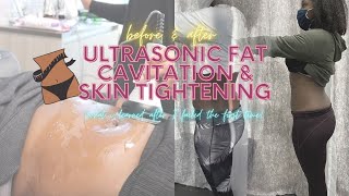 Ultrasonic Fat Cavitation amp Laser Lipo Before and After Review What I Learned After 5 Sessions [upl. by Etana]