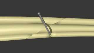 Fracture Fixation Lag Screw [upl. by Llerdnod]