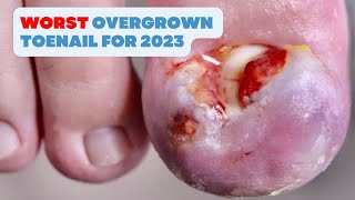 THE BESTWORST OVERGROWN TOENAIL FOR 2023 [upl. by Ruthie]