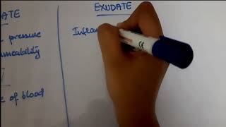 Pleural Effusion  EXUDATE vs TRANSUDATE  Lights criteria [upl. by Lacym]