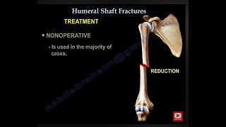 Humerus Fractures  Everything You Need To Know  Dr Nabil Ebraheim [upl. by Hyatt]